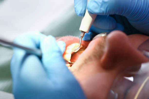 Best Emergency Tooth Extraction in Irwin, SC