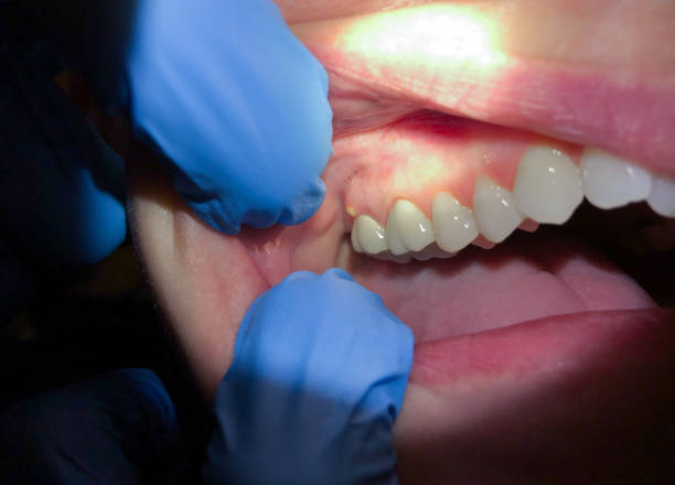 Best Emergency Wisdom Teeth Removal in Irwin, SC