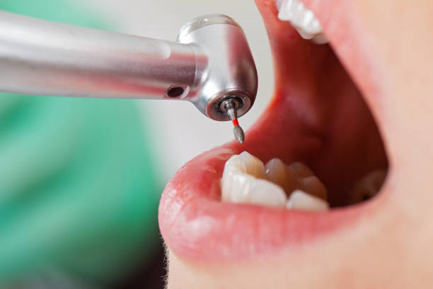 Best Emergency Treatment for Toothache in Irwin, SC